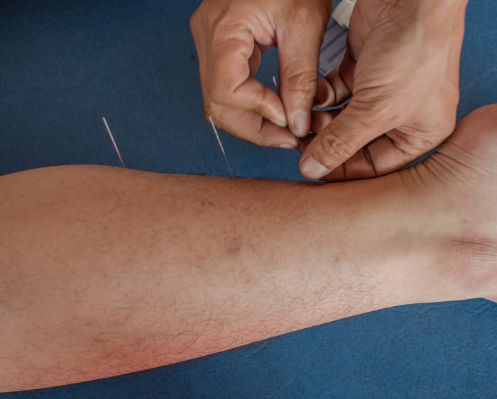 Dry Needling 3 700x563 1