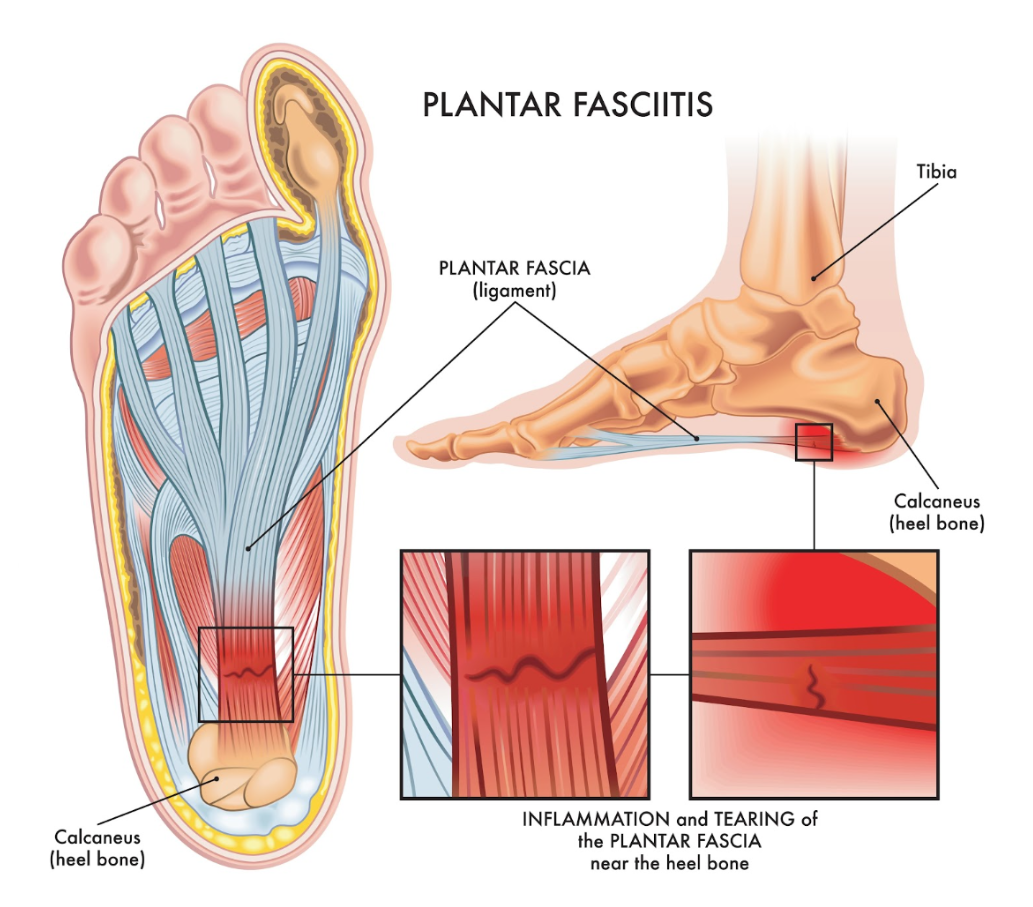 Heel Pain & Plantar Fasciitis